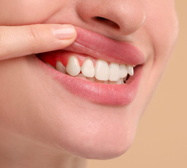 traitement de la gingivite