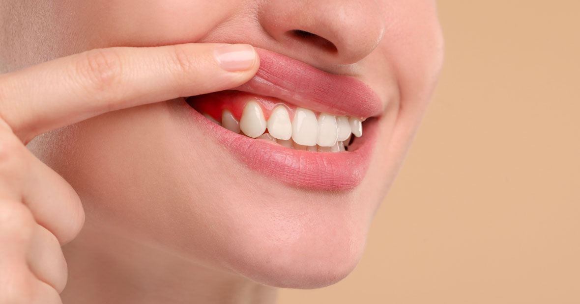 traitement de la gingivite